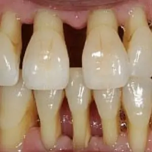 Best solution for long teeth or receding gums