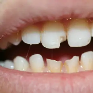 Easy way to fix yellow teeth or chipped tooth