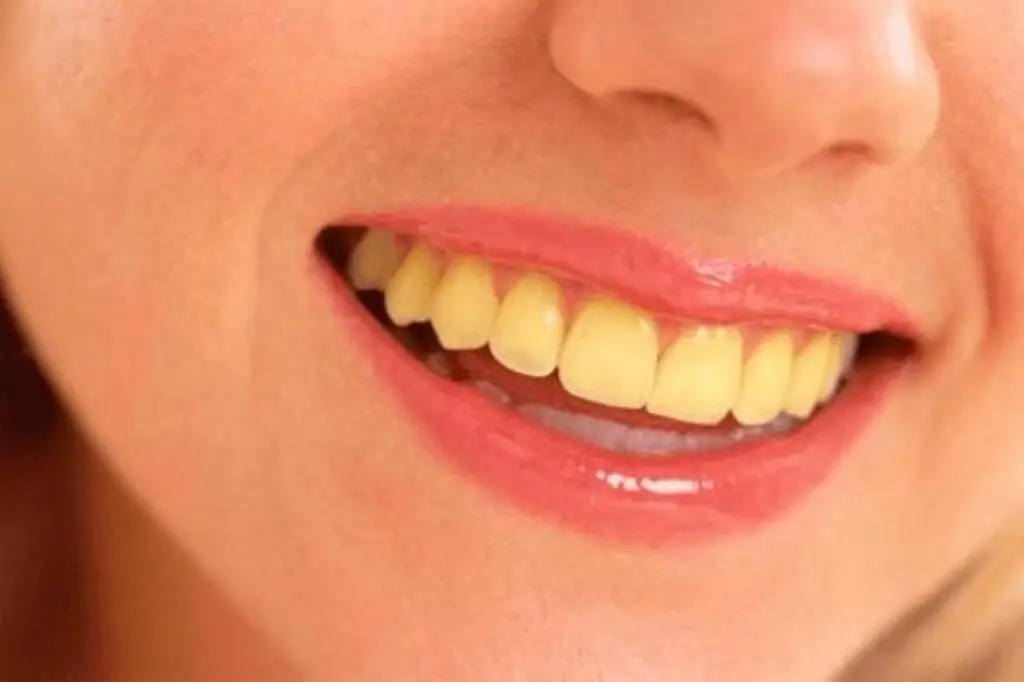 How to remove stains or discoloration on teeth