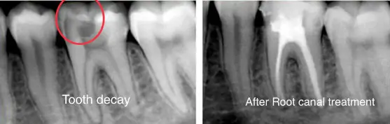 Root Canal Treatment X-Ray