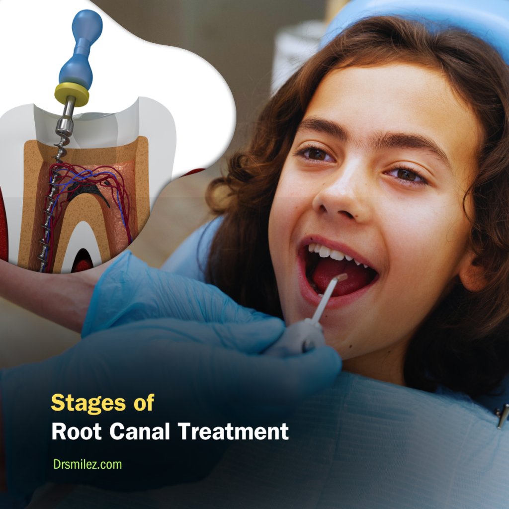 Stages of Root C﻿anal Treatment