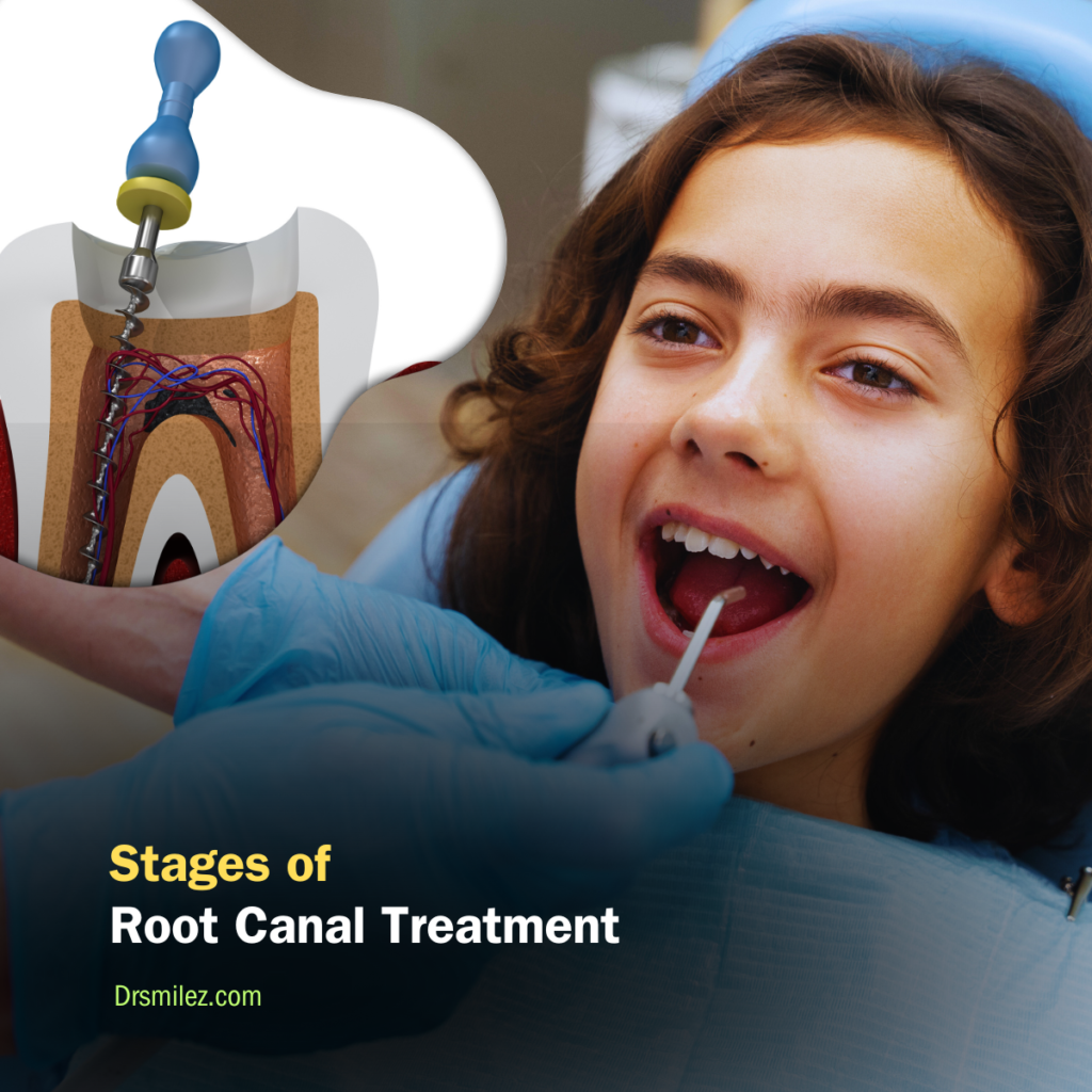 unveiling-the-different-stages-of-the-root-canal-treatment