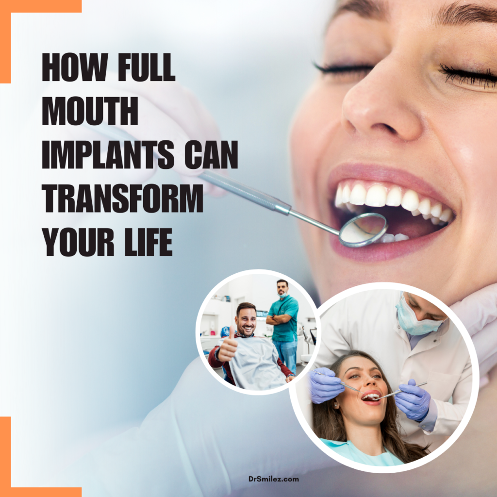 Benefits of full mouth implants